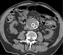 Endoleak - CTisus CT Scan