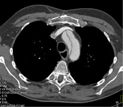 Type A Dissection - CTisus CT Scan