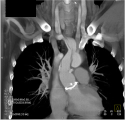 Dissection Right Subclavian Artery - CTisus CT Scan