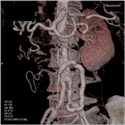 Bypass Grafts From Aortic Graft to Mesenteric Vessels - CTisus CT Scan