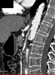 Superior Mesenteric Artery (SMA) Stenosis - CTisus CT Scan