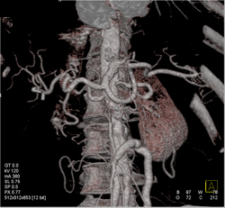 Superior Mesenteric Artery (SMA) Stenosis - CTisus CT Scan