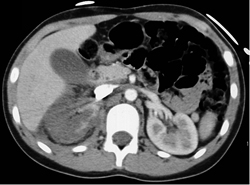 Infarcted Right Kidney - CTisus CT Scan