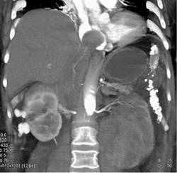 Renal Cell Carcinoma Involves IVC Into Right Atrium - CTisus CT Scan