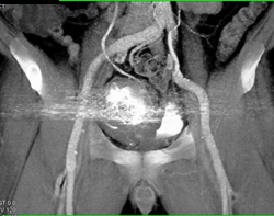 Arteriovenous Malformation (AVM) S/P Embolization - CTisus CT Scan