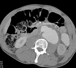 Aortic Pseudoaneurysm - CTisus CT Scan