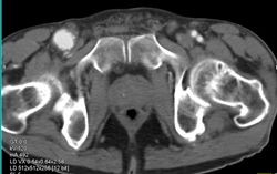 Superficial Femoral Artery (SFA) Aneurysm - CTisus CT Scan