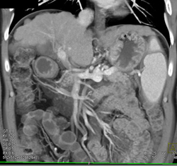 Clot in Portal Vein - CTisus CT Scan