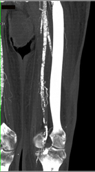 Superficial Femoral Artery (SFA) Stenosis - CTisus CT Scan