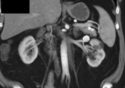 Renal Artery Aneurysm - CTisus CT Scan