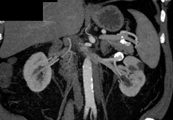 Renal Artery Aneurysm - CTisus CT Scan