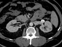 Renal Artery Aneurysm - CTisus CT Scan