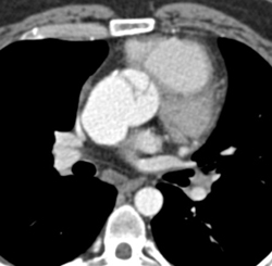 Dilated Aortic Root - CTisus CT Scan