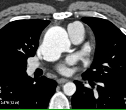 Dilated Aortic Root - CTisus CT Scan