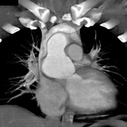 Dilated Aortic Root - CTisus CT Scan