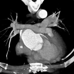 Dilated Aortic Root - CTisus CT Scan