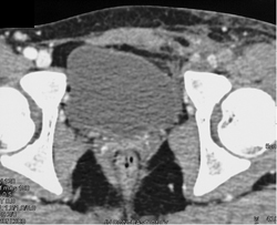 Early Venous Filling on Right Due to Av Fistulae in Thigh - CTisus CT Scan