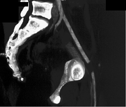 Occluded SFA Due to Trauma - CTisus CT Scan