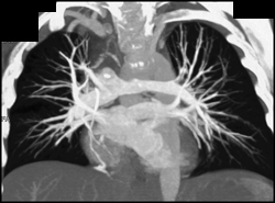 MIP of Pulmonary Arteries - CTisus CT Scan