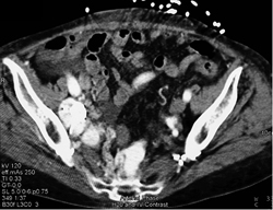 Pelvic Arteriovenous Malformation (AVM) - CTisus CT Scan