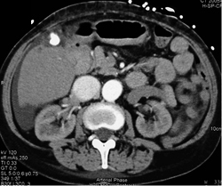 Dilated IVC in Patient With Pelvic Arteriovenous Malformation (AVM) - CTisus CT Scan