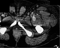 Pseudoaneurysm - CTisus CT Scan