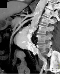 Abdominal Aortic Aneurysm (AAA) W/ Superior Mesenteric Artery (SMA) Stenosis - CTisus CT Scan