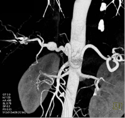 Hepatic Artery Aneurysm - CTisus CT Scan