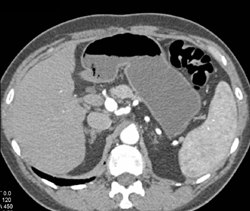 Hepatic Artery Aneurysm - CTisus CT Scan