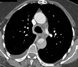 Type B Dissection - CTisus CT Scan