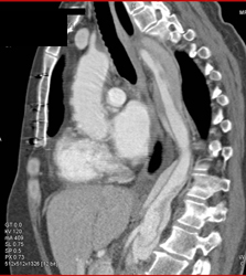 Type B Dissection - CTisus CT Scan