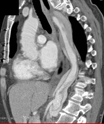 Type B Dissection - CTisus CT Scan