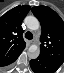 Type B Dissection - CTisus CT Scan