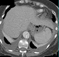 Type B Dissection - CTisus CT Scan