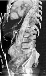 Stent in Aorta With Compromise of Mesenteric Vessels and Collaterals - CTisus CT Scan