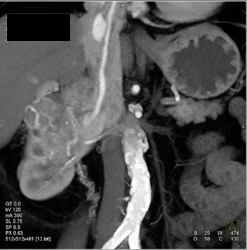 Renal Cell Carcinoma Invades Inferior Vena Cava (IVC) - CTisus CT Scan