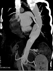 Focal Dissection in Abdominal Abdominal Aorta - CTisus CT Scan