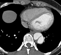 Dissection of Descending Thoracic Aorta - CTisus CT Scan