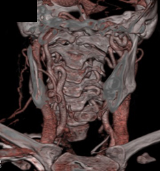 Ectatic Carotids in Loeys-Dietz Syndrome - CTisus CT Scan