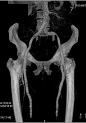 Atherosclerotic Changes in SFAs - CTisus CT Scan