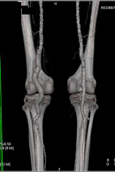 Stent in Popliteal Artery With Nice Runoff Shown With A Range of 3D Tools - CTisus CT Scan