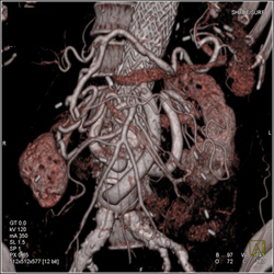 Stent With Patent Vessels - CTisus CT Scan