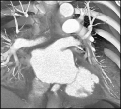 Lv Aneurysm Or Diverticulum - CTisus CT Scan