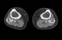 GSW Knee With Injury to SFA With Early AV Shunting - CTisus CT Scan