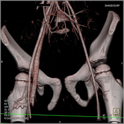 Av Fistulae to Right Groin - CTisus CT Scan