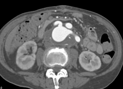 Dilated Grafts to the Aorta for Reimplantation - CTisus CT Scan