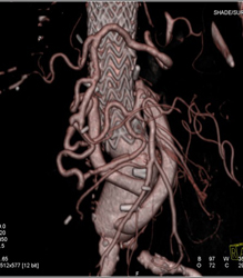 Normal Renal Artery Within Kidney - CTisus CT Scan