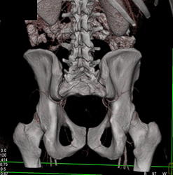 Gluteal Perforators for Reconstructive Breast Surgery - CTisus CT Scan