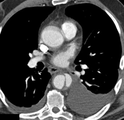 Focal Dissection With Bleed - CTisus CT Scan