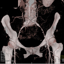 Diseased External Iliac Artery- Left Greater Than Right - CTisus CT Scan